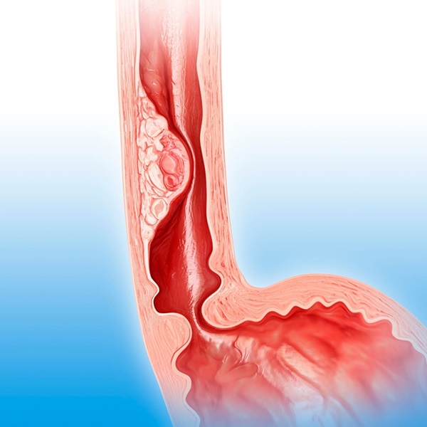 Image: A deep learning system can assist in early-stage detection of esophageal cancers during routine endoscopy (Photo courtesy of Adobe Stock)